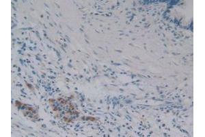 Detection of iPLA2 in Human Pancreas Tissue using Polyclonal Antibody to Phospholipase A2, Calcium Independent (iPLA2) (PNPLA2 anticorps  (AA 484-701))