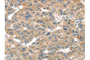 The image on the left is immunohistochemistry of paraffin-embedded Human liver cancer tissue using ABIN7192958(TUSC1 Antibody) at dilution 1/45, on the right is treated with synthetic peptide. (TUSC1 anticorps)