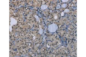 Immunohistochemistry of Human thyroid cancer using GYS1 Polyclonal Antibody at dilution of 1:50 (Glycogen Synthase 1 anticorps)