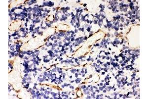 IHC-P: HSP47 antibody testing of human lung cancer tissue (SERPINH1 anticorps  (AA 247-418))