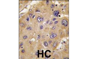 Formalin-fixed and paraffin-embedded human hepatocarcinoma tissue reacted with *ALDH6A1 antibody , which was peroxidase-conjugated to the secondary antibody, followed by DAB staining. (ALDH6A1 anticorps  (C-Term))