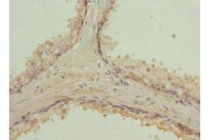 Immunohistochemistry of paraffin-embedded human prostate cancer using ABIN7167389 at dilution of 1:100 (RAB9A anticorps  (AA 122-201))