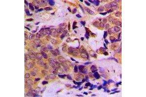 Immunohistochemical analysis of DOK1 staining in human breast cancer formalin fixed paraffin embedded tissue section. (DOK1 anticorps)