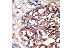 Formalin-fixed and paraffin-embedded human cancer tissue reacted with the primary antibody, which was peroxidase-conjugated to the secondary antibody, followed by DAB staining.