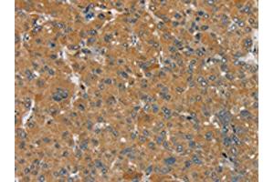The image on the left is immunohistochemistry of paraffin-embedded Human liver cancer tissue using ABIN7192302(SEMA6D Antibody) at dilution 1/25, on the right is treated with synthetic peptide.