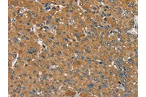 The image on the left is immunohistochemistry of paraffin-embedded Human liver cancer tissue using ABIN7192302(SEMA6D Antibody) at dilution 1/25, on the right is treated with synthetic peptide. (SEMA6D anticorps)