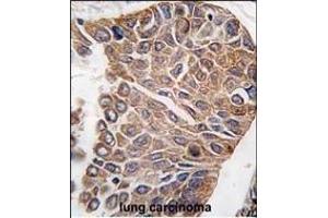 Formalin-fixed and paraffin-embedded human lung carcinoma tissue reacted with AKT2 antibody (C-term), which was peroxidase-conjugated to the secondary antibody, followed by DAB staining. (AKT2 anticorps  (C-Term))