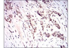 Immunohistochemical analysis of paraffin-embedded stomach cancer tissues using NFE2L2 mouse mAb with DAB staining.