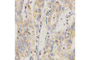 Immunohistochemistry of paraffin-embedded human stomach cancer using MAP2K6 antibody at dilution of 1:200 (x400 lens) (MAP2K6 anticorps  (AA 1-334))