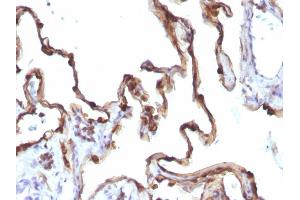 Formalin-fixed, paraffin-embedded human Lung Carcinoma stained with Cytokeratin 7 Mouse Monoclonal Antibody (KRT7/1198). (Cytokeratin 7 anticorps)