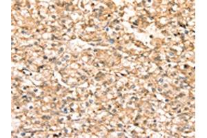 The image on the left is immunohistochemistry of paraffin-embedded Human prostate cancer tissue using ABIN7192443(SLC25A38 Antibody) at dilution 1/20, on the right is treated with synthetic peptide. (SLC25A38 anticorps)