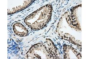 Immunohistochemical staining of paraffin-embedded Adenocarcinoma of ovary tissue N93ing anti-CYP1A2 mouse monoclonal antibody. (CYP1A2 anticorps)