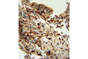INDO antibody (Center) (ABIN650713 and ABIN2839358) immunohistochemistry analysis in formalin fixed and paraffin embedded human lung carcinoma followed by peroxidase conjugation of the secondary antibody and DAB staining. (IDO1 anticorps  (AA 79-105))