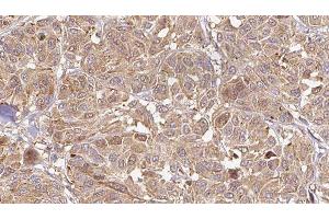 ABIN6276505 at 1/100 staining Human Melanoma tissue by IHC-P. (C19orf10 anticorps)