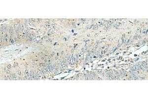Immunohistochemistry of paraffin-embedded Human colorectal cancer tissue using DENND6A Polyclonal Antibody at dilution of 1:120(x200) (FAM116A anticorps)
