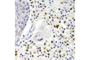 Immunohistochemistry of paraffin-embedded human lung cancer using GEMIN2 Antibody (ABIN1872798) at dilution of 1:200 (40x lens). (SIP1 anticorps)