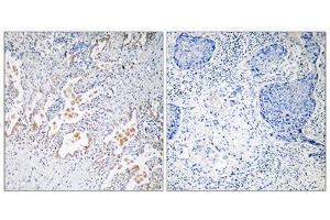 Immunohistochemistry analysis of paraffin-embedded human lung carcinoma tissue using GNB5 antibody. (GNB5 anticorps  (Internal Region))