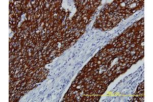 Immunoperoxidase of monoclonal antibody to FGFR2 on formalin-fixed paraffin-embedded human stomach carcinoma tissue.