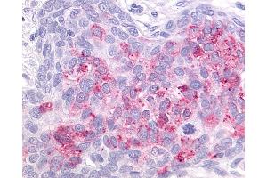 Anti-GPR55 antibody IHC of human Ovary, Carcinoma.