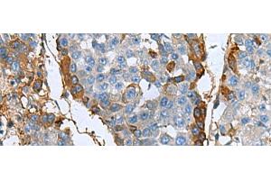 Immunohistochemistry of paraffin-embedded Human liver cancer tissue using TGFBI Polyclonal Antibody at dilution of 1:60(x200)