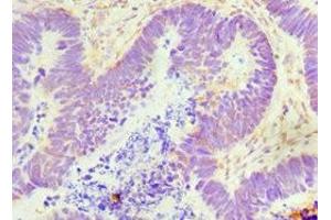 Immunohistochemistry of paraffin-embedded human ovarian cancer using ABIN7154549 at dilution of 1:100 (GDF5 anticorps  (AA 202-501))