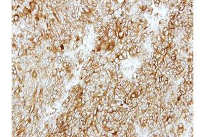 IHC-P Image Immunohistochemical analysis of paraffin-embedded DLD1 xenograft, using GMDS, antibody at 1:500 dilution. (GMDS anticorps)
