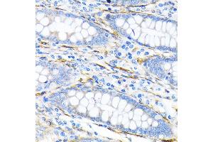 Immunohistochemistry of paraffin-embedded human liver cancer using LPP Rabbit mAb (ABIN7268284) at dilution of 1:100 (40x lens).