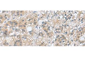 Immunohistochemistry of paraffin-embedded Human liver cancer tissue using RAB39A Polyclonal Antibody at dilution of 1:70(x200) (RAB39A anticorps)