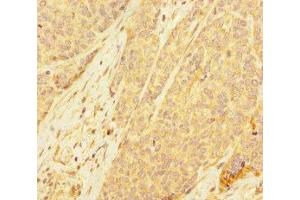 Immunohistochemistry of paraffin-embedded human ovarian cancer using ABIN7168417 at dilution of 1:100 (PDE6A anticorps  (AA 656-860))
