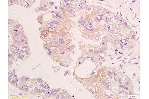 Formalin-fixed and paraffin embedded human colon carcinoma labeled with Anti-CD24 Polyclonal Antibody, Unconjugated  at 1:200, followed by conjugation to the secondary antibody and DAB staining