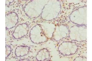 Immunohistochemistry of paraffin-embedded human colon cancer using ABIN7167630 at dilution of 1:100 (FAM82B anticorps  (AA 13-314))