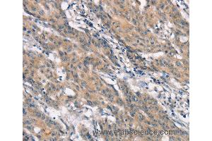 Immunohistochemistry of Human gastric cancer using CRKL Polyclonal Antibody at dilution of 1:25 (CrkL anticorps)