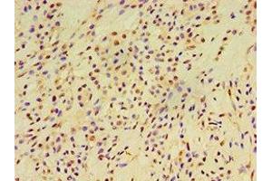 Immunohistochemistry of paraffin-embedded human breast cancer using ABIN7152252 at dilution of 1:100 (EXOC2 anticorps  (AA 1-220))