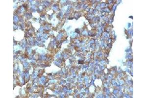 Formalin-fixed, paraffin-embedded human ovarian carcinoma stained with CD99 antibody (MIC2/877). (CD99 anticorps)