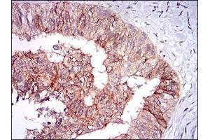 Immunohistochemical analysis of paraffin-embedded ovarian cancer tissues using TIE1 mouse mAb with DAB staining.