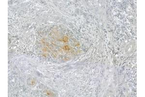 ABIN6258387 and ABIN6274993 at 1/100 staining human tongue carcinoma by IHC-P. (CEP78 anticorps  (Internal Region))