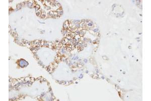 IHC-P Image Immunohistochemical analysis of paraffin-embedded human ovarian cancer, using CD146, antibody at 1:500 dilution. (MCAM anticorps  (N-Term))