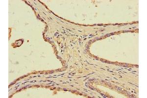 Immunohistochemistry of paraffin-embedded human prostate cancer using ABIN7172291 at dilution of 1:100 (TLL1 anticorps  (AA 522-643))