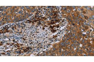 Immunohistochemistry of paraffin-embedded Human cervical cancer using HYAL3 Polyclonal Antibody at dilution of 1:40 (HYAL3 anticorps)
