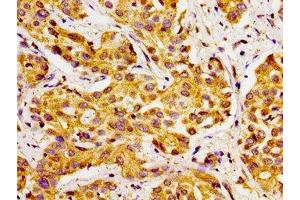 Immunohistochemistry of paraffin-embedded human liver cancer using ABIN7170770 at dilution of 1:100