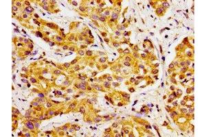Immunohistochemistry of paraffin-embedded human liver cancer using ABIN7170770 at dilution of 1:100 (CYP27A1 anticorps  (AA 290-407))