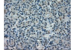 Immunohistochemical staining of paraffin-embedded Carcinoma of thyroid tissue using anti-PORmouse monoclonal antibody. (POR anticorps)