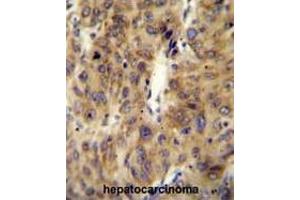 ACF Antibody (C-term) immunohistochemistry analysis in formalin fixed and paraffin embedded human hepatocarcinoma followed by peroxidase conjugation of the secondary antibody and DAB staining.