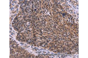 Immunohistochemistry of Human colon cancer using CDC5L Polyclonal Antibody at dilution of 1:30 (CDC5L anticorps)