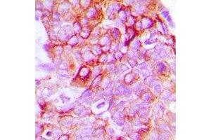 Immunohistochemical analysis of EPHB1/2 staining in human breast cancer formalin fixed paraffin embedded tissue section. (EPHB1/2 anticorps)