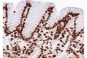 ABIN6267040 at 1/100 staining human Stomach carcinoma tissue sections by IHC-P.