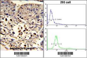 (LEFT)Formalin-fixed and paraffin-embedded human hepatocarcinoma reacted with ETHE1 Antibody , which was peroxidase-conjugated to the secondary antibody, followed by DAB staining. (ETHE1 anticorps  (C-Term))