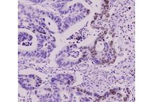 Immunohistochemistry paraffin embedded sections of human colorectal cancer tissue were incubated with SUMO2 monoclonal antibody, clone AT10F1  (1 : 50) for 2 hours at room temperature. (SUMO2 anticorps  (AA 1-93))