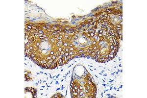 Immunohistochemistry of paraffin-embedded human skin cancer using Cytokeratin 14 (KRT14) (KRT14) Rabbit mAb (ABIN7268091) at dilution of 1:100 (40x lens).