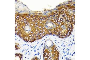 Immunohistochemistry of paraffin-embedded human skin cancer using Cytokeratin 14 (KRT14) (KRT14) Rabbit mAb (ABIN7268091) at dilution of 1:100 (40x lens). (KRT14 anticorps)
